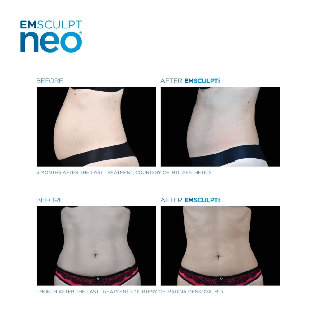Trial】Emsculpt NEO® Ultimate Body Contouring & Strengthening - 1 time –  EVRbeauty