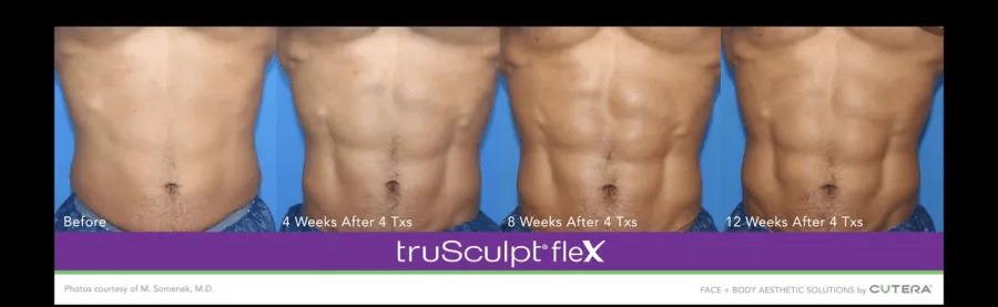 Body Sculpting  Discover the Best Body Sculpting Treatments in Ridgefield,  CT with Morph Med Spa — Morph Med
